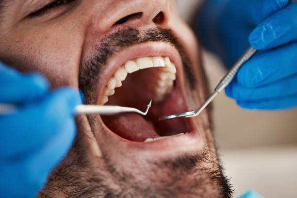 Best Broken or Chipped Tooth Repair in Gregory, SD